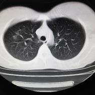 【病例】支原体肺炎1例CT影像表现