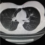 【病例】支原体肺炎1例CT影像表现