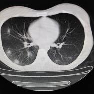【病例】支原体肺炎1例CT影像表现
