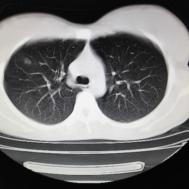 【病例】支原体肺炎1例CT影像表现