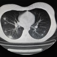 【病例】支原体肺炎1例CT影像表现