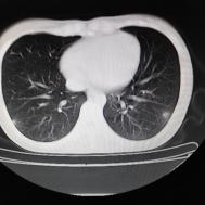 【病例】支原体肺炎1例CT影像表现