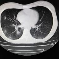 【病例】支原体肺炎1例CT影像表现
