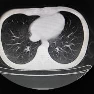 【病例】支原体肺炎1例CT影像表现