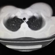 【病例】支原体肺炎1例CT影像表现