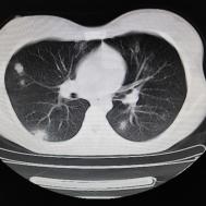 【病例】支原体肺炎1例CT影像表现