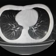 【病例】支原体肺炎1例CT影像表现