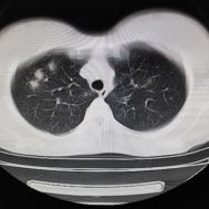 【病例】支原体肺炎1例CT影像表现