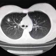 【病例】支原体肺炎1例CT影像表现