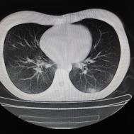 【病例】支原体肺炎1例CT影像表现