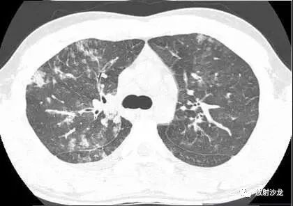 【病例】肺炎支原体肺炎1例CT影像表现