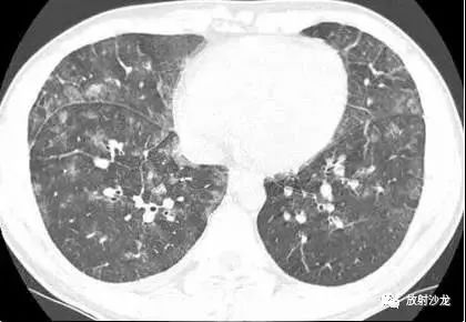 【病例】肺炎支原体肺炎1例CT影像表现