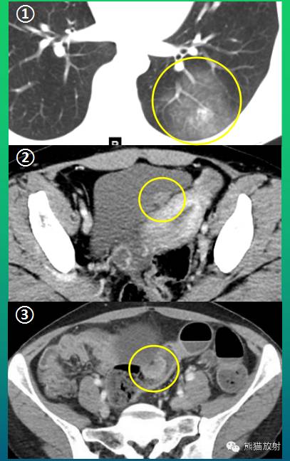 罕少见的子宫内膜异位症