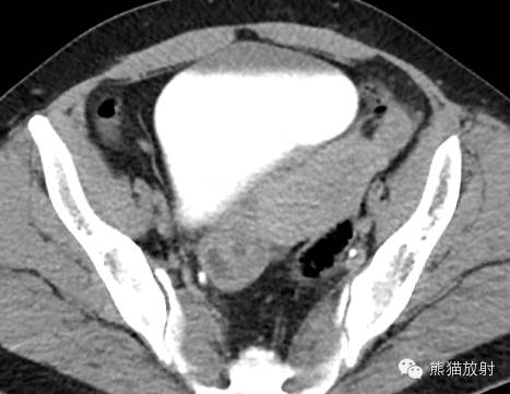 罕少见的子宫内膜异位症