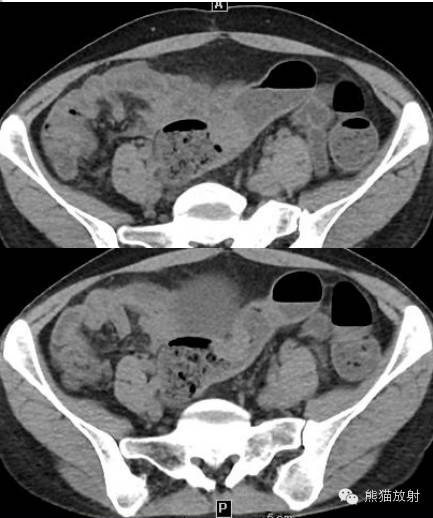 罕少见的子宫内膜异位症