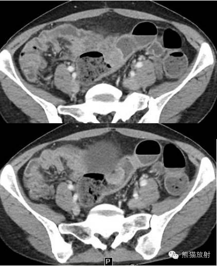 罕少见的子宫内膜异位症