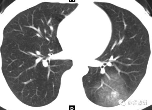 罕少见的子宫内膜异位症