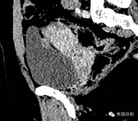 罕少见的子宫内膜异位症