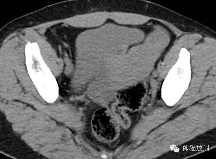 罕少见的子宫内膜异位症