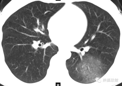 罕少见的子宫内膜异位症