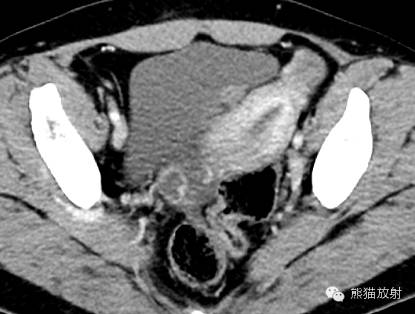 罕少见的子宫内膜异位症