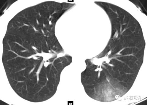 罕少见的子宫内膜异位症
