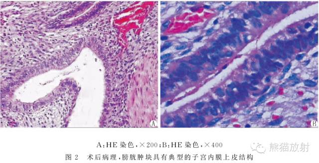 罕少见的子宫内膜异位症