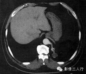 肺隔离症的CT报告书写技巧与提示