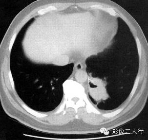 肺隔离症的CT报告书写技巧与提示
