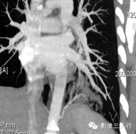 肺隔离症的CT报告书写技巧与提示