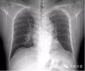 结节病的CT诊断