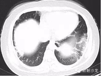 结节病的CT诊断