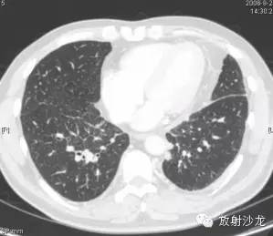 结节病的CT诊断