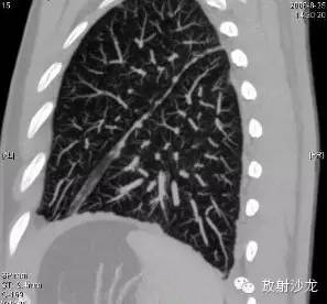 结节病的CT诊断