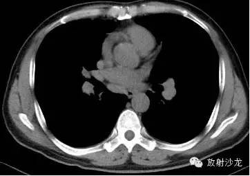 结节病的CT诊断