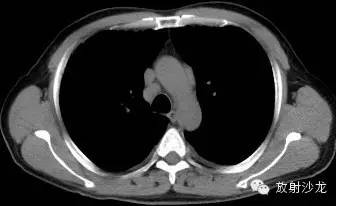 结节病的CT诊断