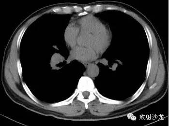 结节病的CT诊断