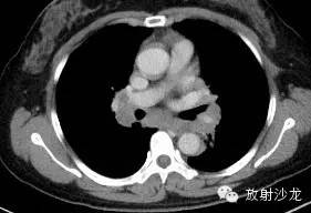 结节病的CT诊断