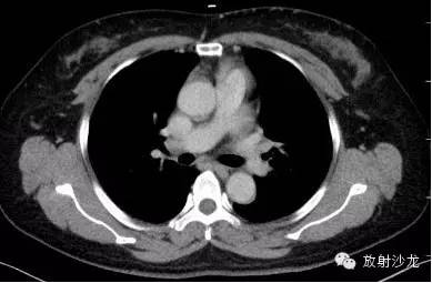 结节病的CT诊断