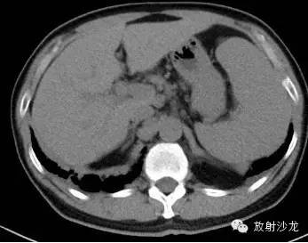 结节病的CT诊断
