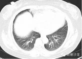 结节病的CT诊断