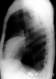 大叶性肺炎的X线报告书写技巧与提示