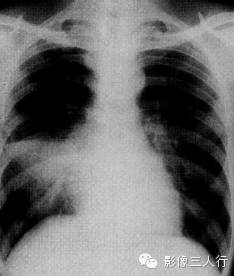 大叶性肺炎的X线报告书写技巧与提示