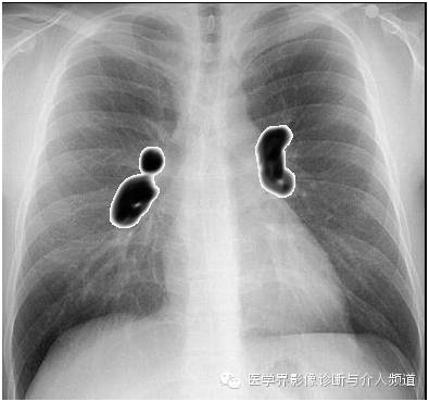 【病例】肺结节病1例X线影像表现