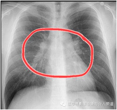 【病例】肺结节病1例X线影像表现