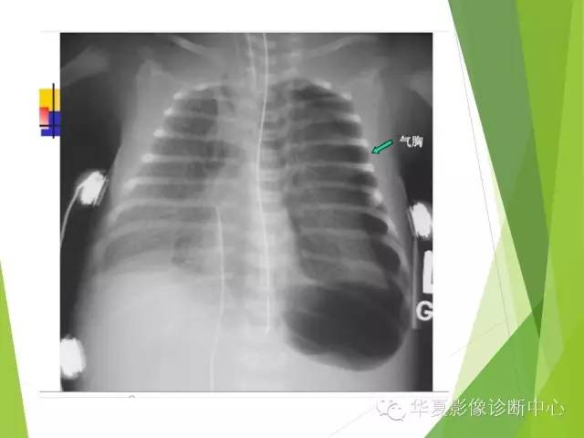 【PPT】新生儿常见的胸部病变