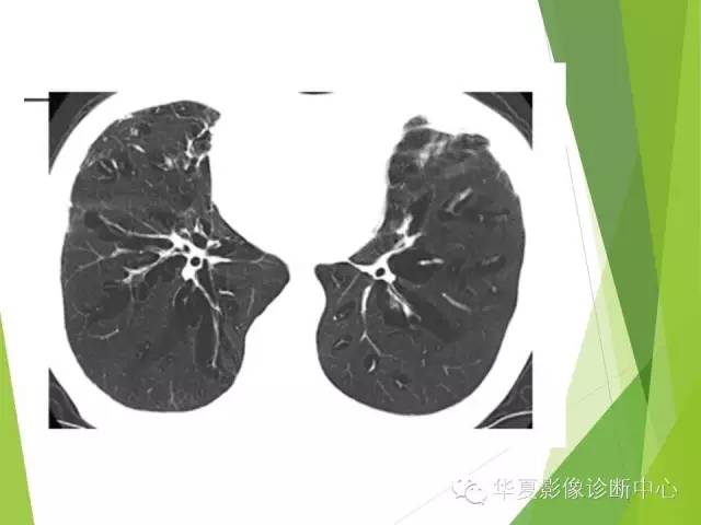 【PPT】新生儿常见的胸部病变