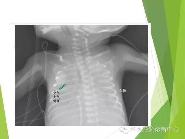 【PPT】新生儿常见的胸部病变