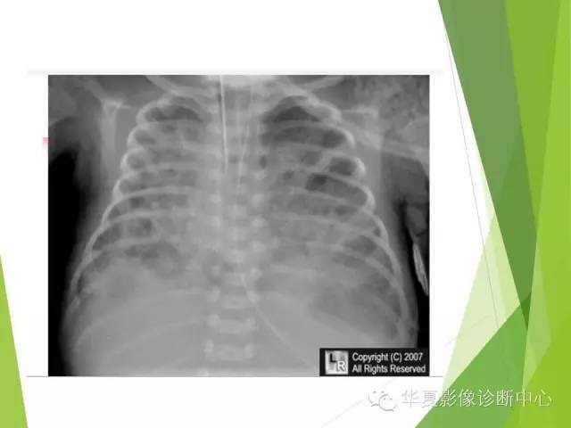 【PPT】新生儿常见的胸部病变