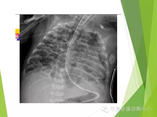 【PPT】新生儿常见的胸部病变